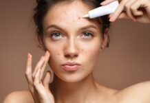 Як обрати крем від акне?